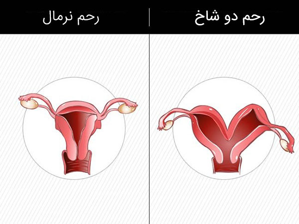 عکس رحم دو شاخ